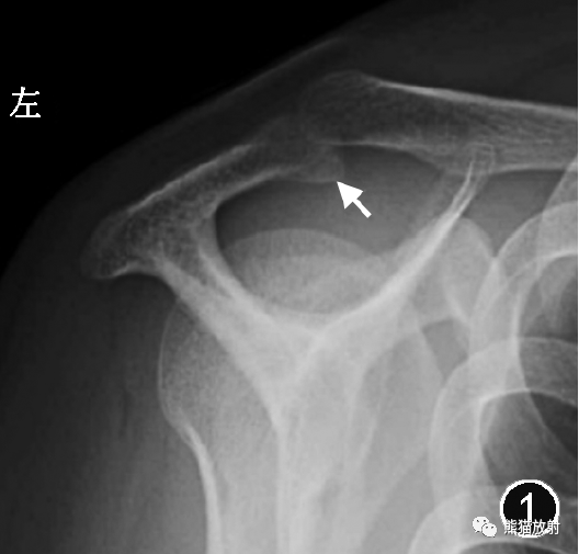 肩峰下撞击综合征的临床及影像表现-1