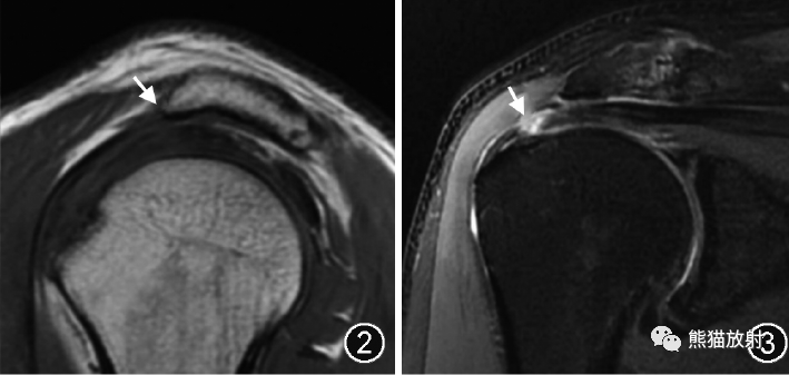 肩峰下撞击综合征的临床及影像表现-2