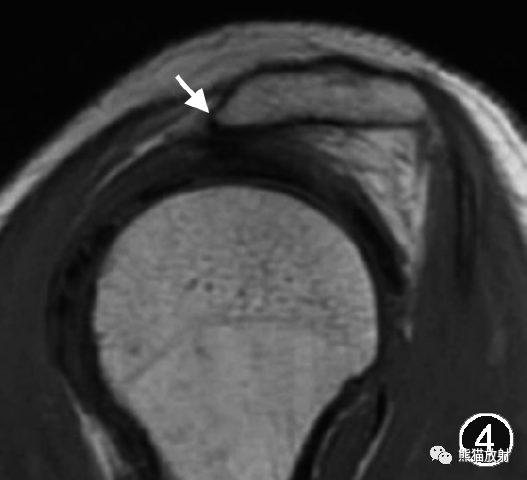 肩峰下撞击综合征的临床及影像表现-3