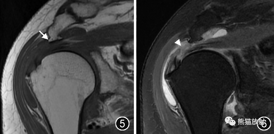 肩峰下撞击综合征的临床及影像表现-4