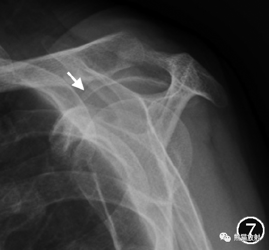 肩峰下撞击综合征的临床及影像表现-5