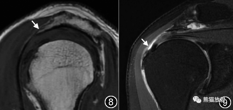 肩峰下撞击综合征的临床及影像表现-6