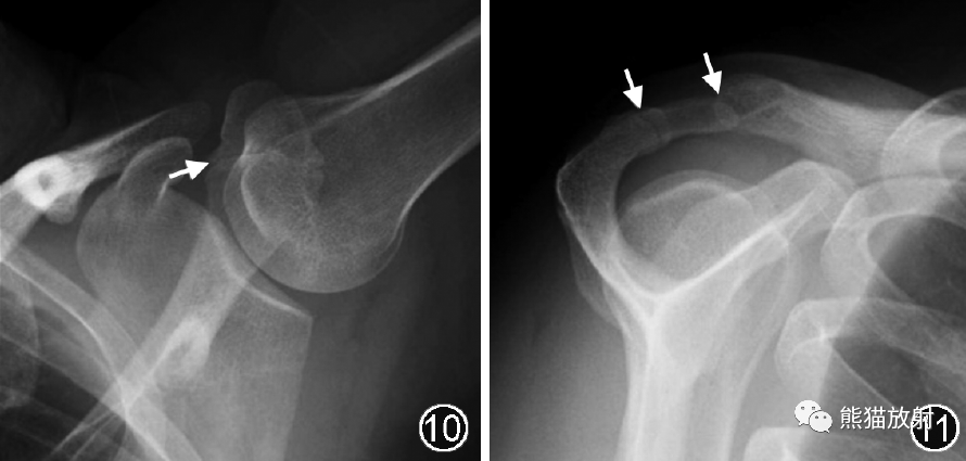 肩峰下撞击综合征的临床及影像表现-7