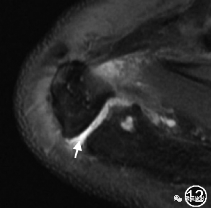 肩峰下撞击综合征的临床及影像表现-8