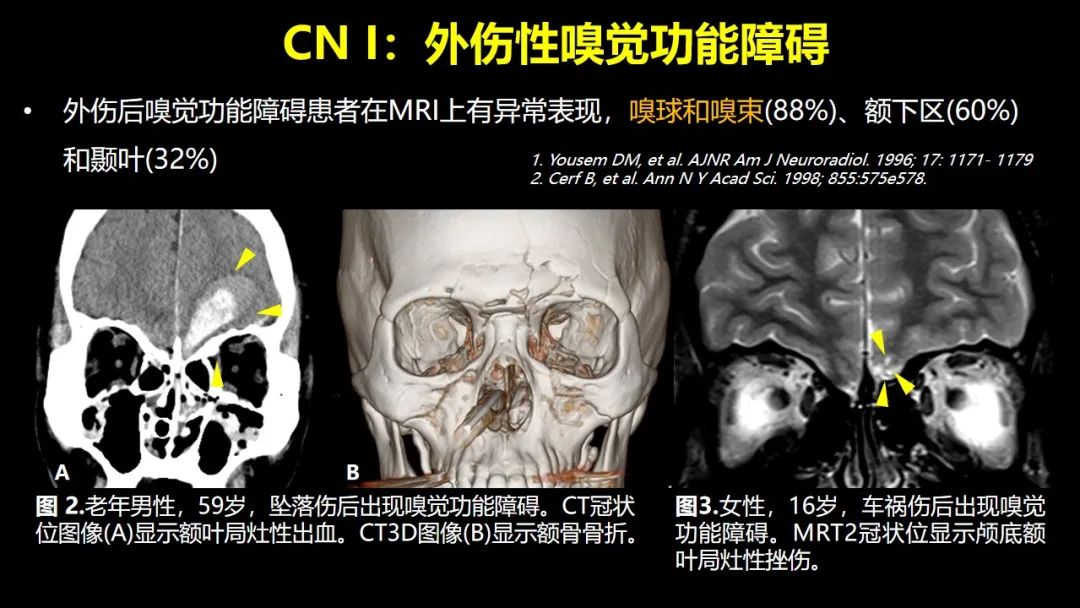 【PPT】创伤性颅神经损伤的影像表现-11