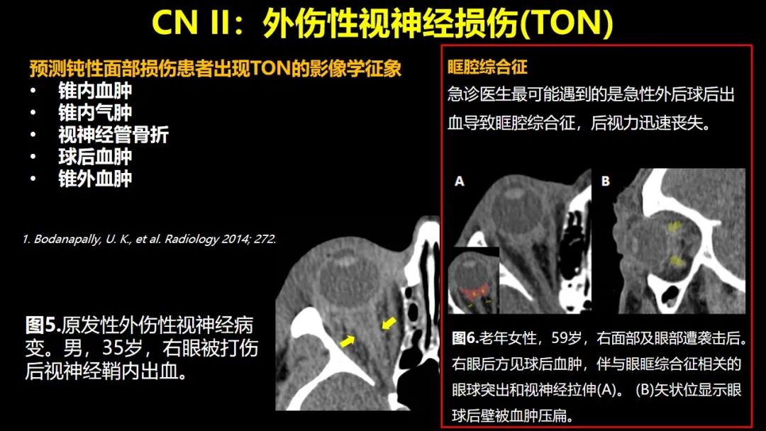 【PPT】创伤性颅神经损伤的影像表现-15