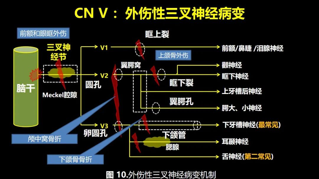 【PPT】创伤性颅神经损伤的影像表现-23