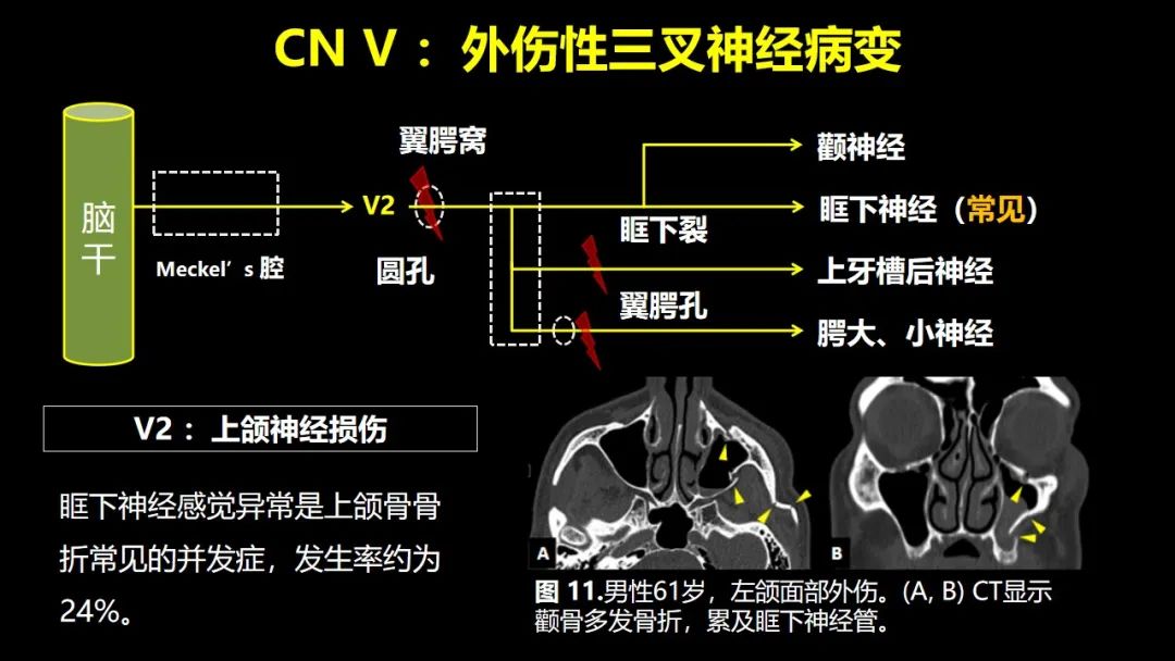 【PPT】创伤性颅神经损伤的影像表现-27