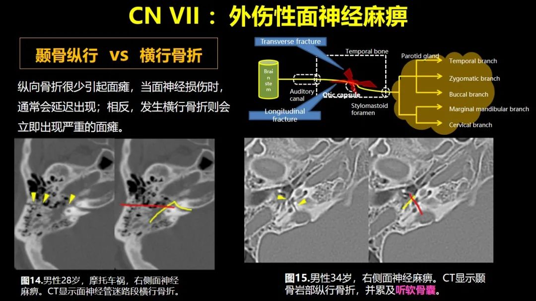 【PPT】创伤性颅神经损伤的影像表现-33