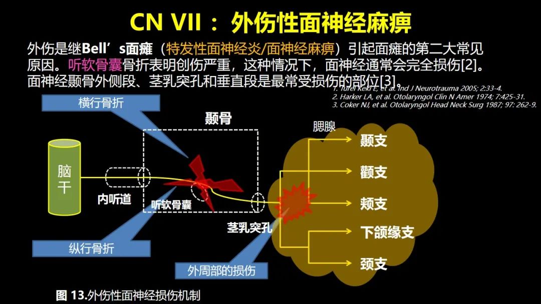 【PPT】创伤性颅神经损伤的影像表现-31