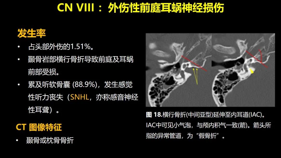 【PPT】创伤性颅神经损伤的影像表现-39