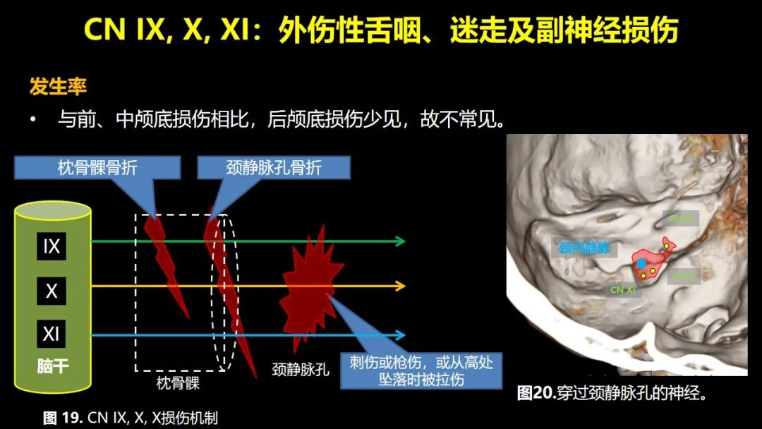 【PPT】创伤性颅神经损伤的影像表现-41