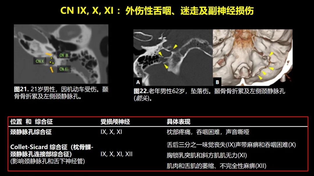 【PPT】创伤性颅神经损伤的影像表现-43