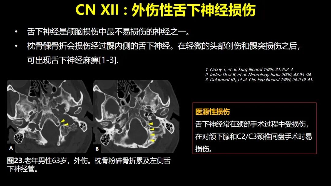 【PPT】创伤性颅神经损伤的影像表现-45
