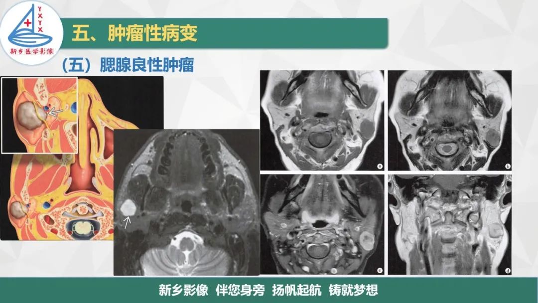 【PPT】医学影像诊断学教材解读—口腔颌面部疾病2-17