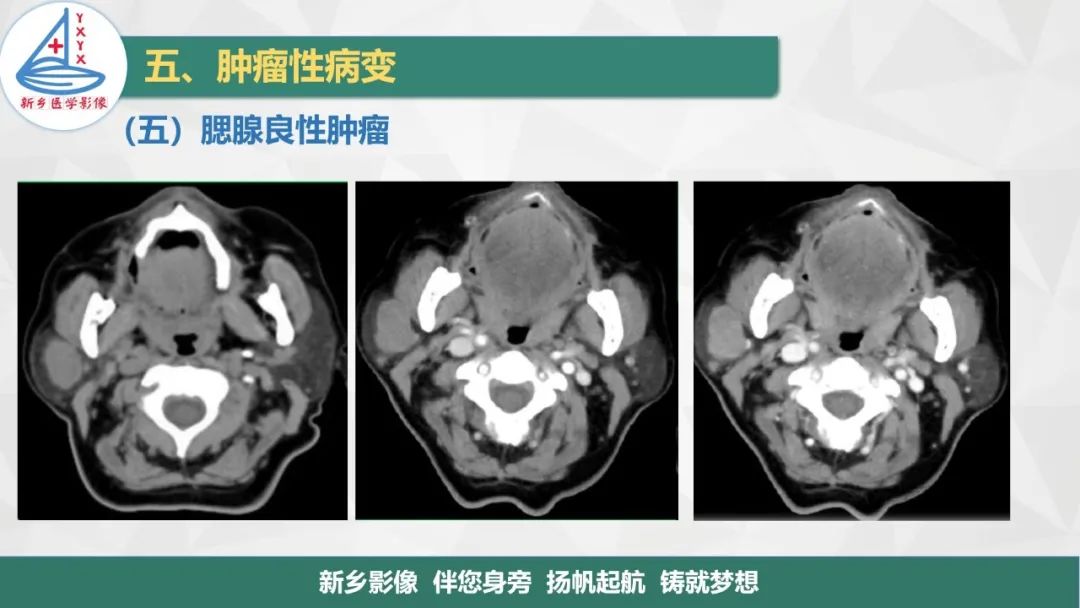 【PPT】医学影像诊断学教材解读—口腔颌面部疾病2-18