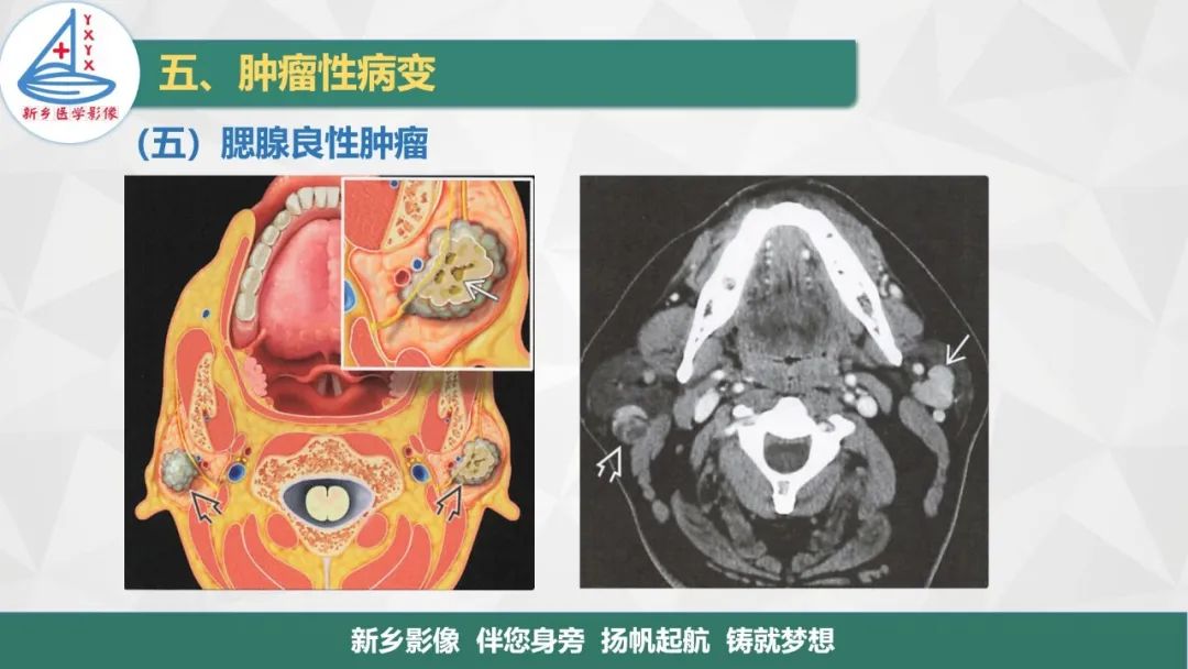 【PPT】医学影像诊断学教材解读—口腔颌面部疾病2-19