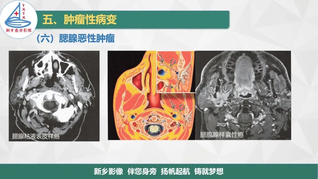 【PPT】医学影像诊断学教材解读—口腔颌面部疾病2-24