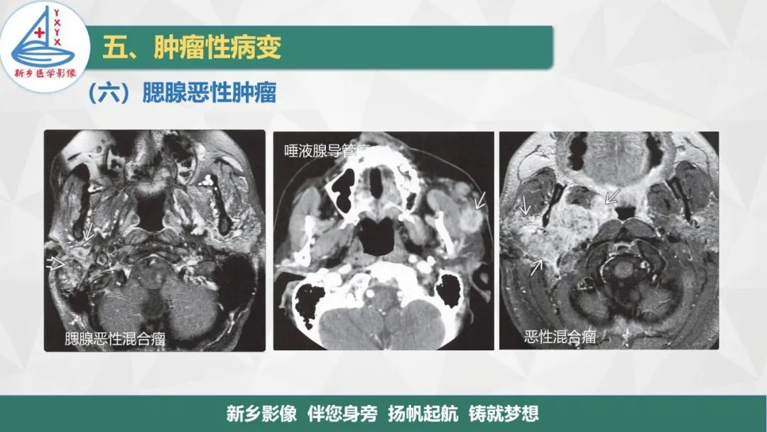 【PPT】医学影像诊断学教材解读—口腔颌面部疾病2-25