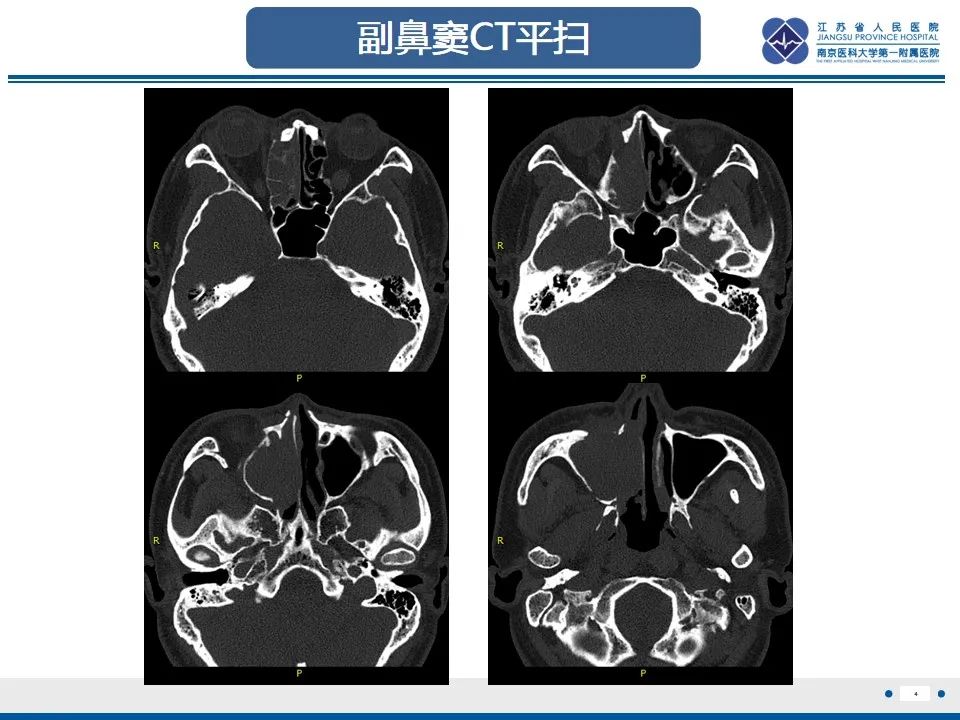 【PPT】鼻腔鼻窦鳞状细胞癌-5