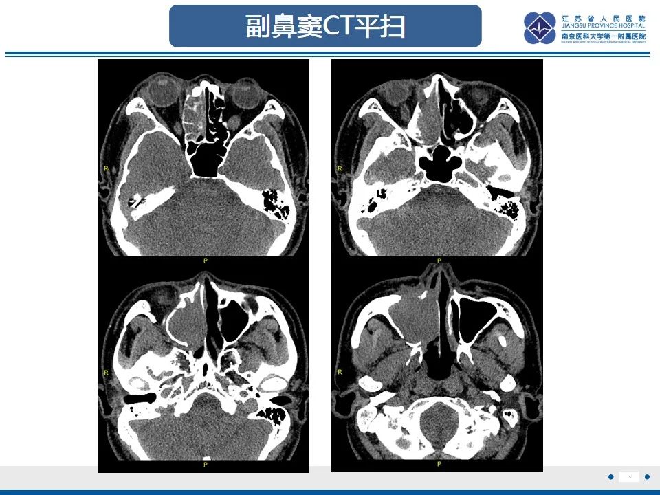 【PPT】鼻腔鼻窦鳞状细胞癌-4