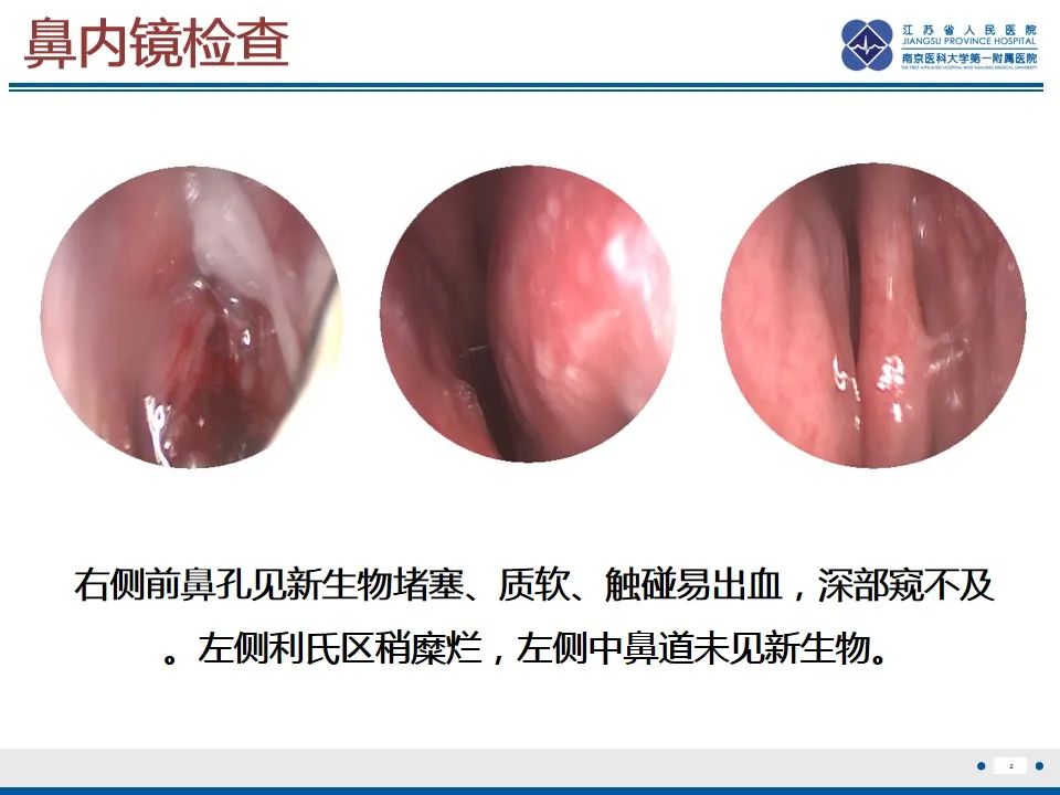 【PPT】鼻腔鼻窦鳞状细胞癌-3