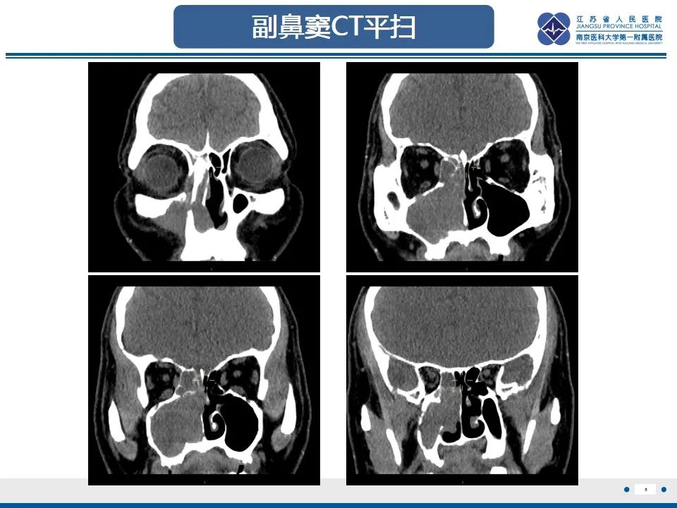 【PPT】鼻腔鼻窦鳞状细胞癌-6