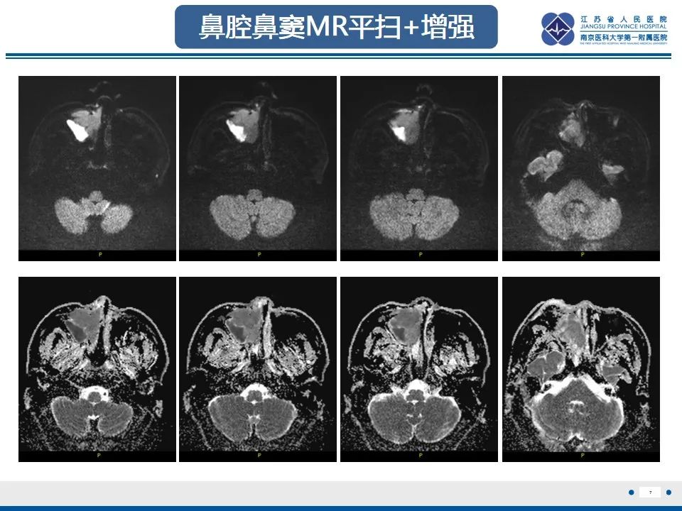 【PPT】鼻腔鼻窦鳞状细胞癌-8