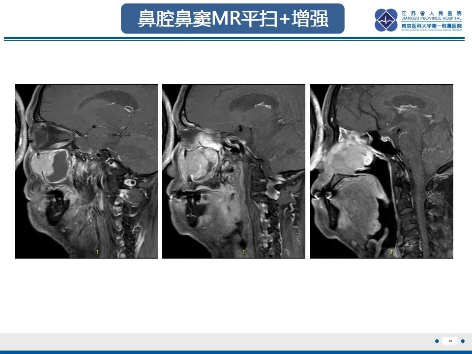 【PPT】鼻腔鼻窦鳞状细胞癌-11