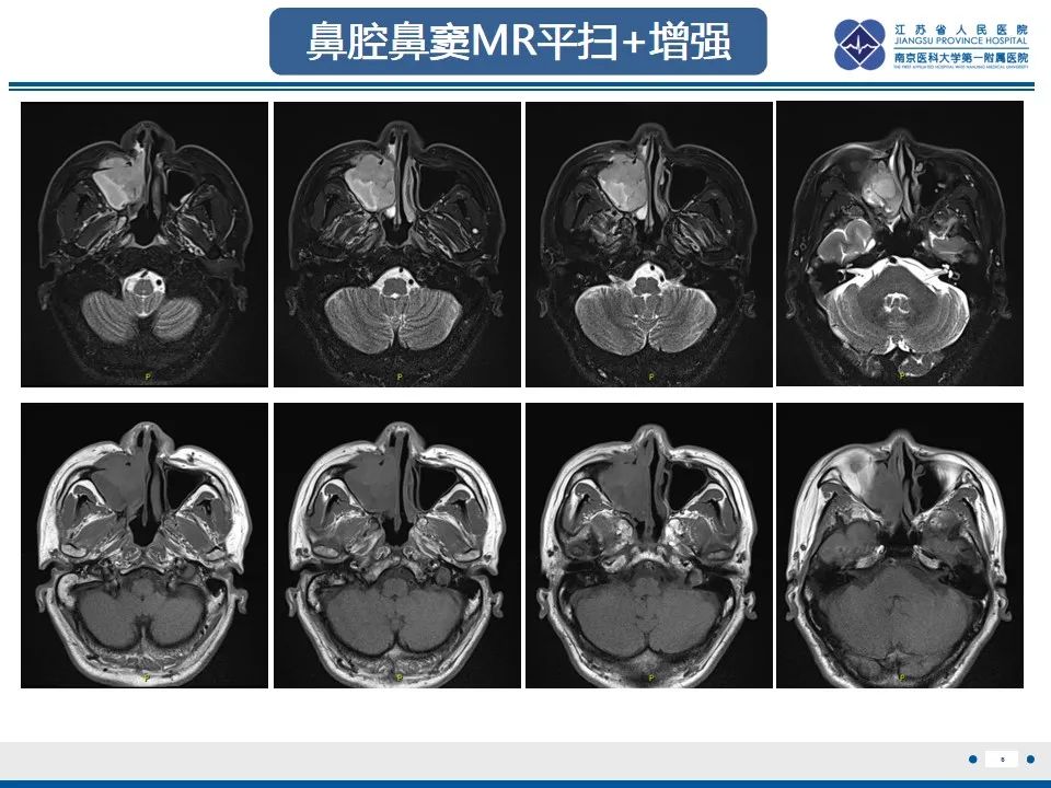 【PPT】鼻腔鼻窦鳞状细胞癌-7