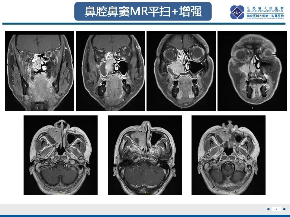 【PPT】鼻腔鼻窦鳞状细胞癌-10