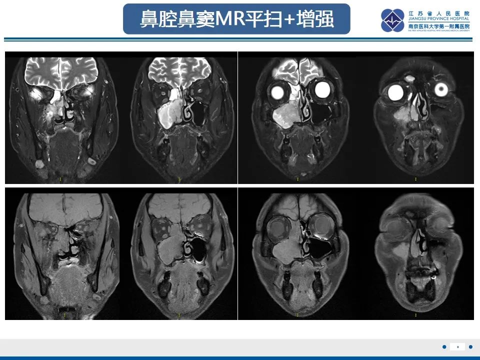 【PPT】鼻腔鼻窦鳞状细胞癌-9