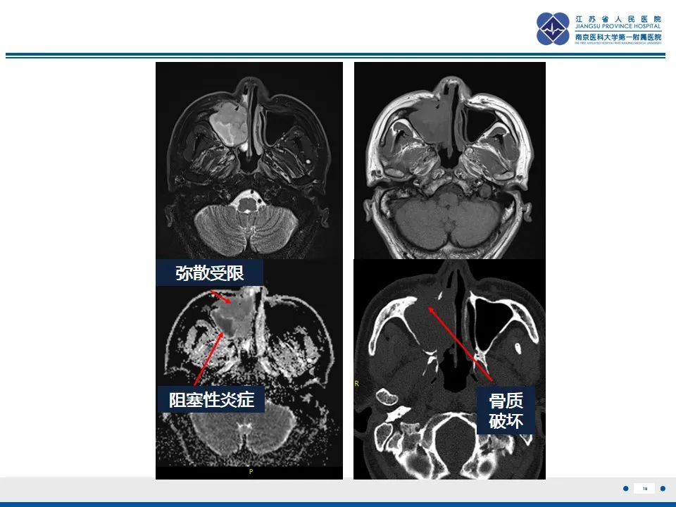 【PPT】鼻腔鼻窦鳞状细胞癌-19