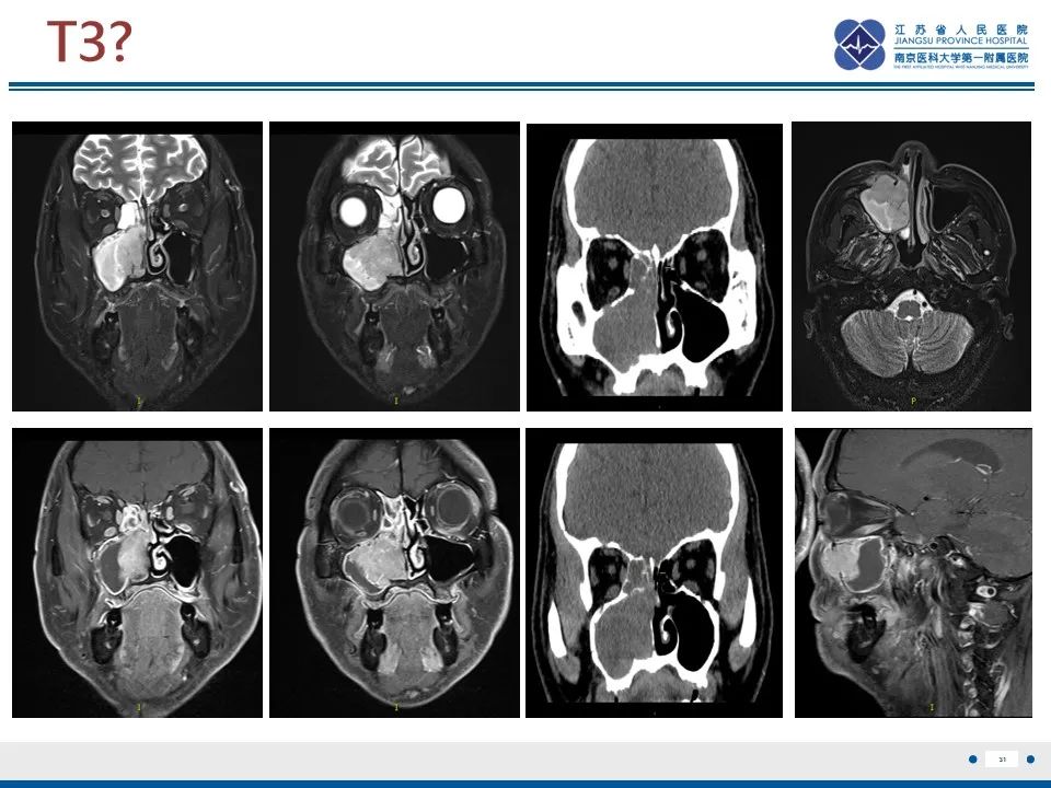 【PPT】鼻腔鼻窦鳞状细胞癌-32