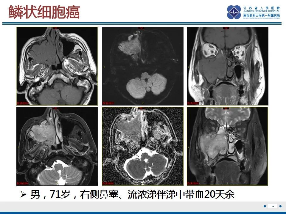 【PPT】鼻腔鼻窦鳞状细胞癌-35