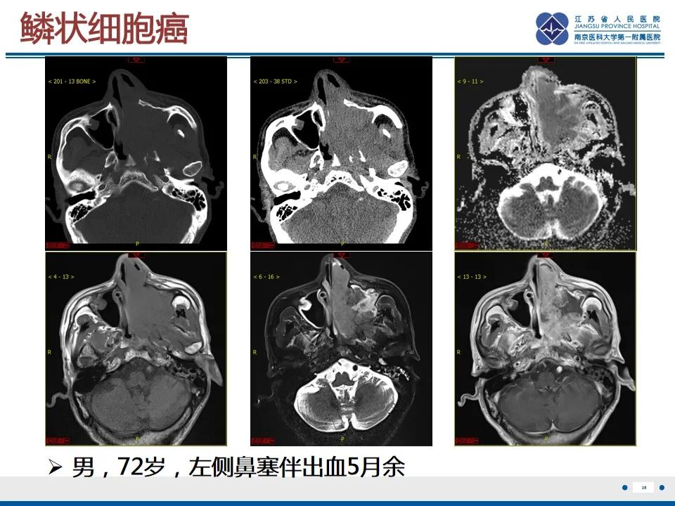【PPT】鼻腔鼻窦鳞状细胞癌-36