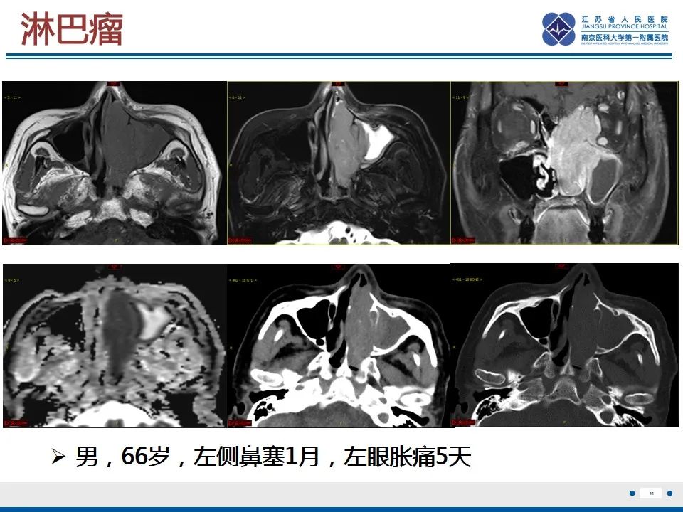 【PPT】鼻腔鼻窦鳞状细胞癌-42