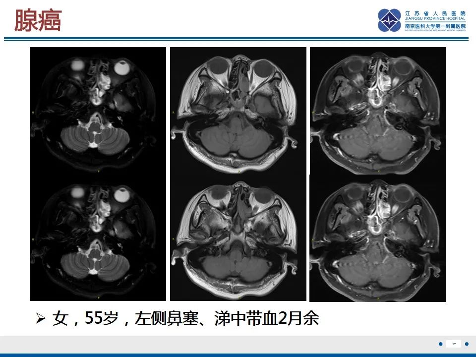 【PPT】鼻腔鼻窦鳞状细胞癌-38