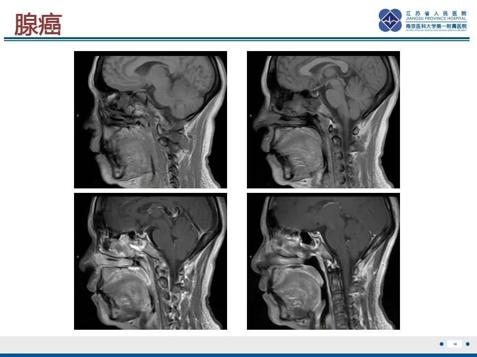【PPT】鼻腔鼻窦鳞状细胞癌-39