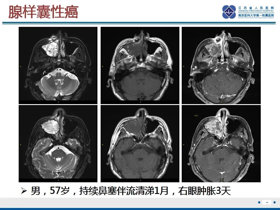 【PPT】鼻腔鼻窦鳞状细胞癌-44