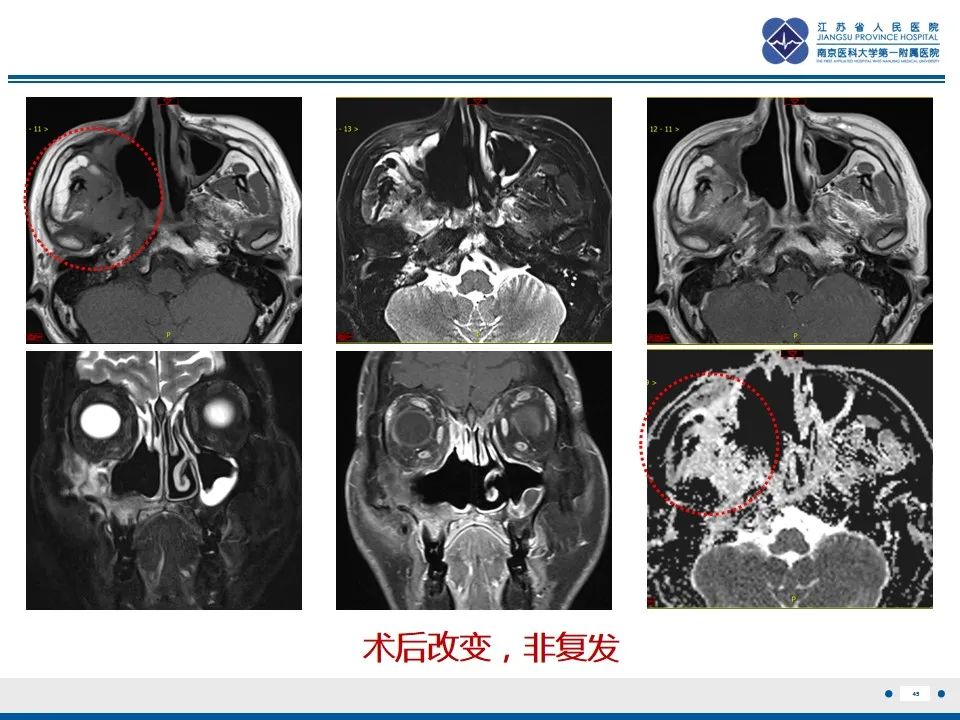 【PPT】鼻腔鼻窦鳞状细胞癌-46