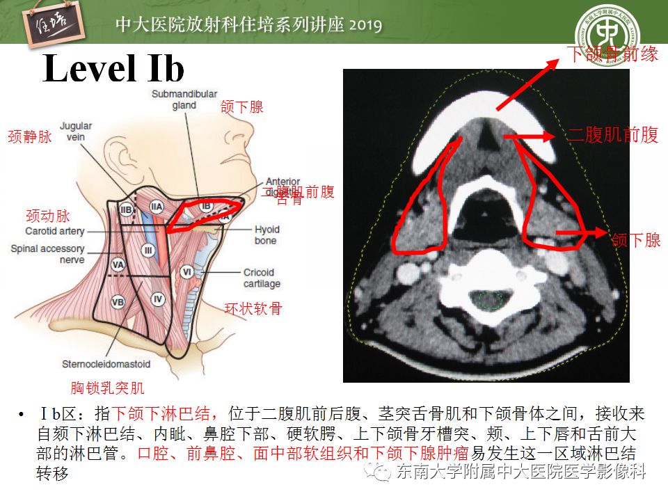 【PPT】颈部淋巴结的影像解剖及常见病变的影像表现-9