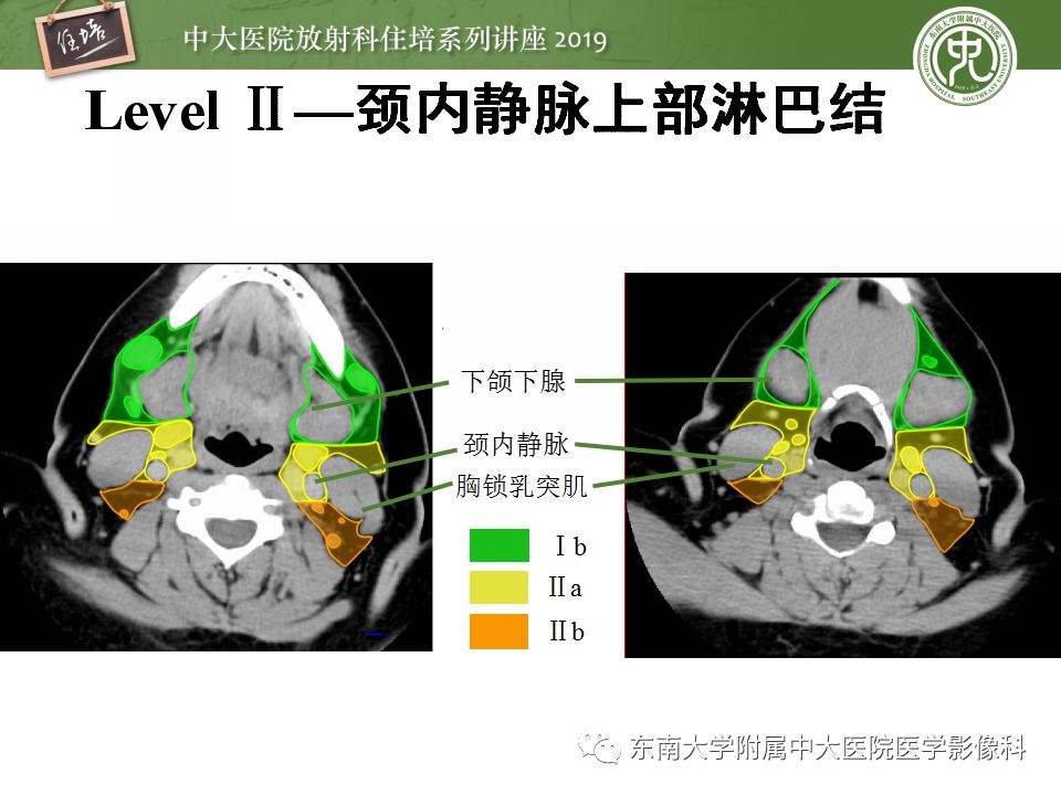 【PPT】颈部淋巴结的影像解剖及常见病变的影像表现-11