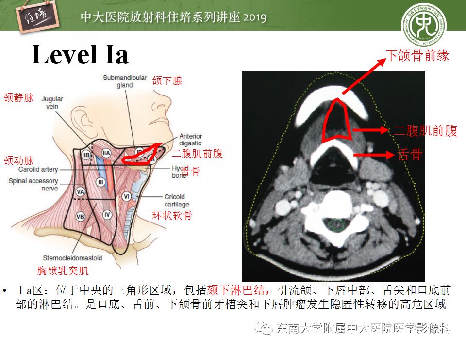 【PPT】颈部淋巴结的影像解剖及常见病变的影像表现-8