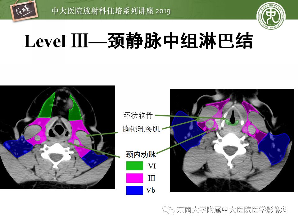 【PPT】颈部淋巴结的影像解剖及常见病变的影像表现-12