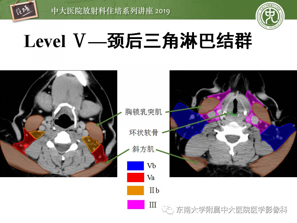 【PPT】颈部淋巴结的影像解剖及常见病变的影像表现-16