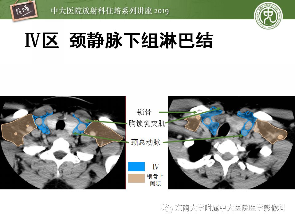 【PPT】颈部淋巴结的影像解剖及常见病变的影像表现-14