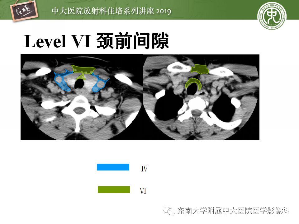 【PPT】颈部淋巴结的影像解剖及常见病变的影像表现-18