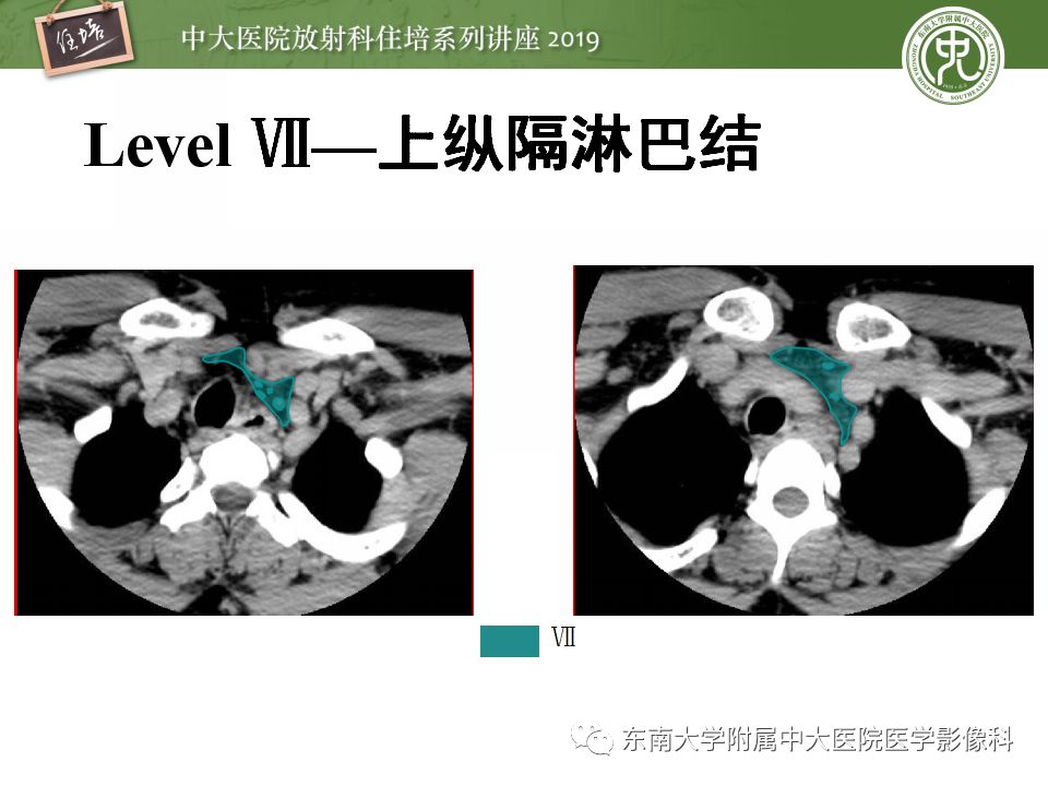 【PPT】颈部淋巴结的影像解剖及常见病变的影像表现-20