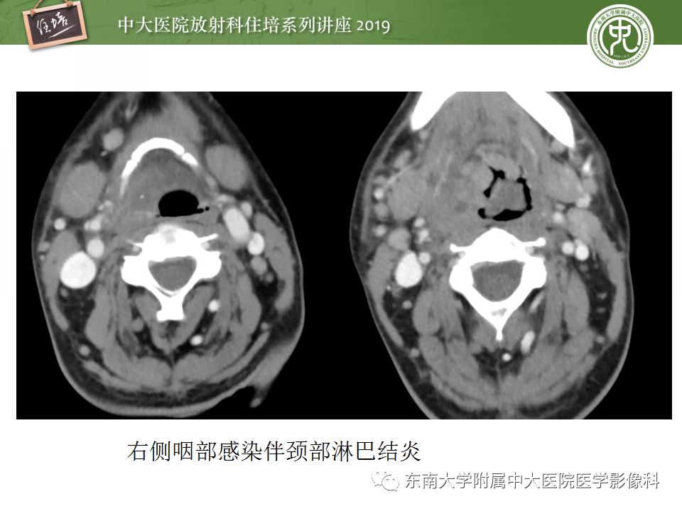 【PPT】颈部淋巴结的影像解剖及常见病变的影像表现-25